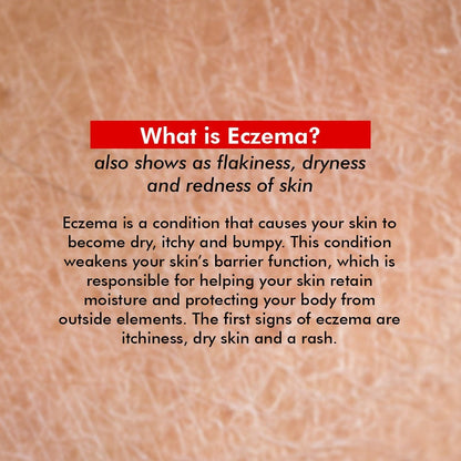 Hydrating Body Cream | Treats Dry & Itchy Skin  | 150 gm