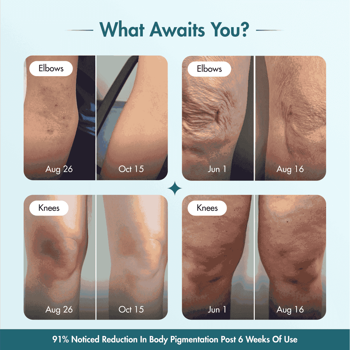 Pigmentation & Dark Spot Corrector Gel Cream | Kojic Acid & Niacinamide | 50 gm