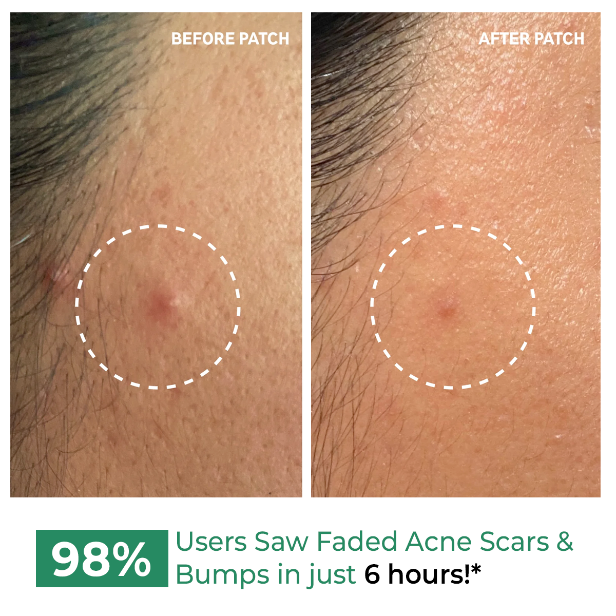 Self Dissolving Microneedle Acne Patches | Salicyclic Acid, Azelaic Acid | Results in 6 hrs | 8 Patches