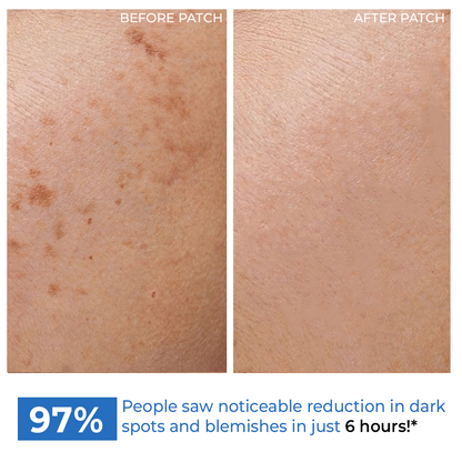 Dark Spot Lightening Microneedle Patch | Gallic Acid, Niacinamide | Results in 6 hrs | Self Dissolving | 4 Patches